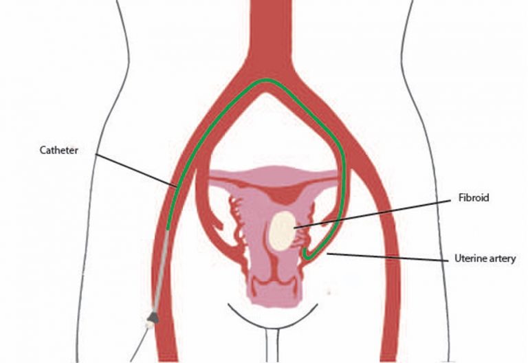 Uterine Fibroid Embolization Near Me Effective Relief from Fibroid-Related Symptoms