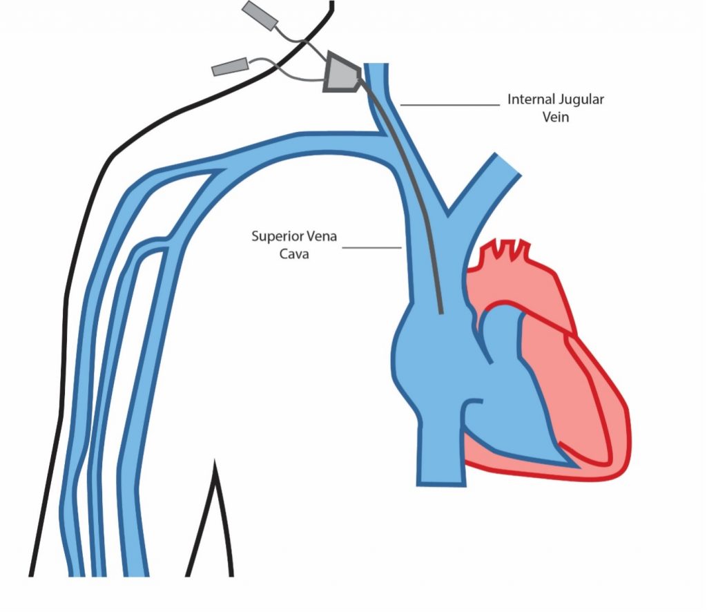 Central Venous Access Dr Ryan McConell